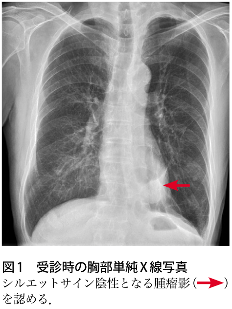 図1　受診時の胸部単純X線写真