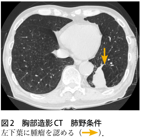図2　胸部造影CT　肺野条件
