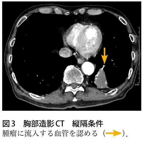 図3　胸部造影CT　縦隔条件