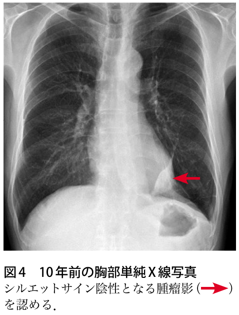 図4　10年前の胸部単純X線写真