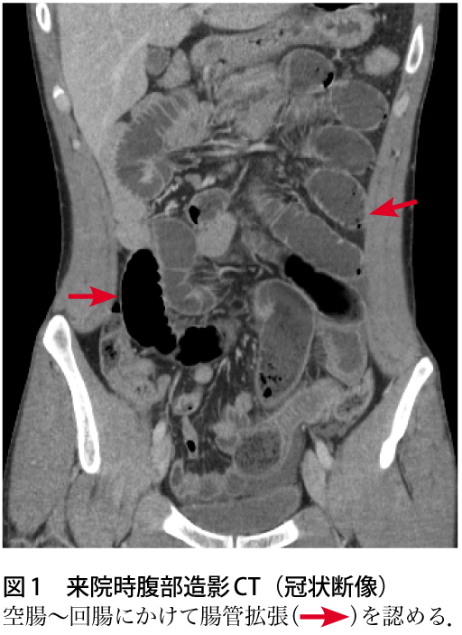 図1　来院時腹部造影CT（冠状断像）