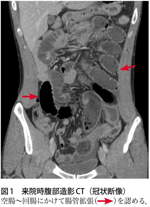 解答 解説 下腹部痛で受診した歳代男性 原因は 実践 画像診断q A 羊土社 レジデントノート 羊土社