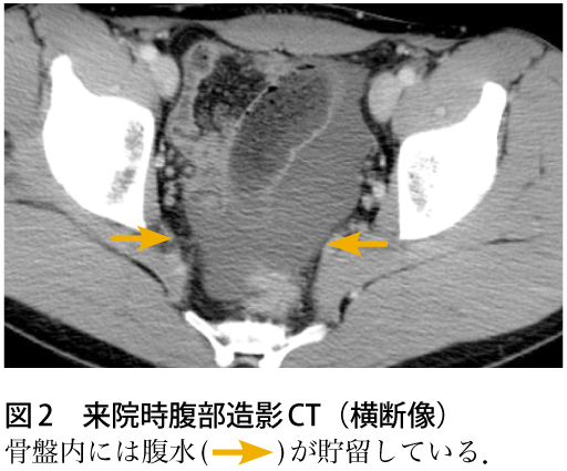 図2　来院時腹部造影CT（横断像）
