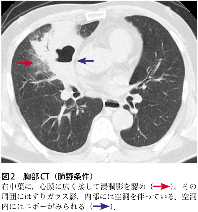 痰の貯留肺炎 – 痰貯留による合併症 – FTLN