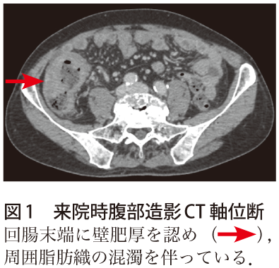 図1　来院時腹部造影CT軸位断