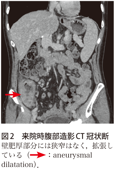 図2　来院時腹部造影CT冠状断