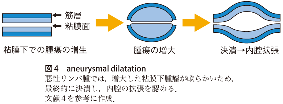 図4　aneurysmal dilatation