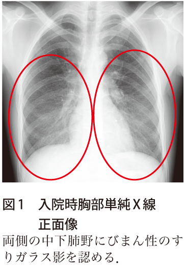 図1　入院時胸部単純X線　正面像