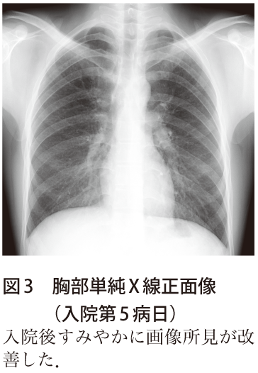 図3　胸部単純X 線正面像（入院第5病日）
