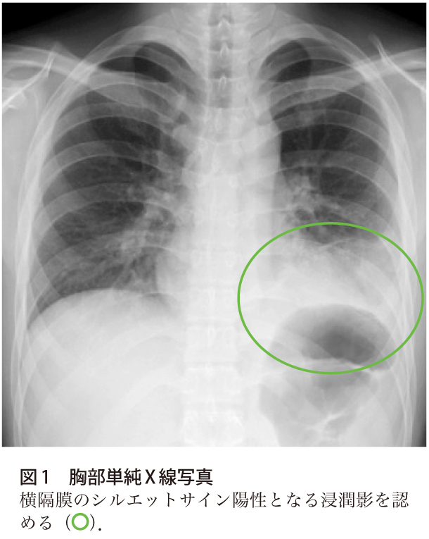 図1　胸部単純X線写真