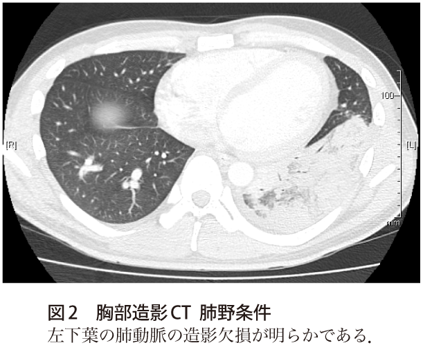 図2　胸部造影CT肺野条件
