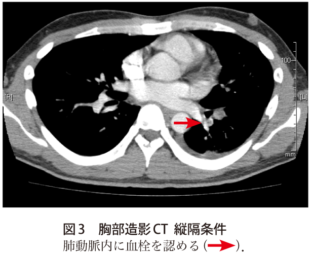 図3　胸部造影CT縦隔条件