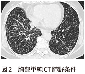 図2　胸部単純CT肺野条件