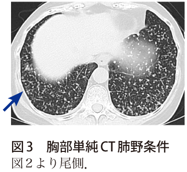 図3　胸部単純CT肺野条件
