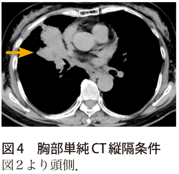 図4　胸部単純CT縦隔条件