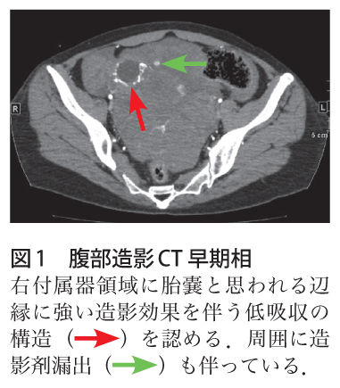図1　腹部造影CT 早期