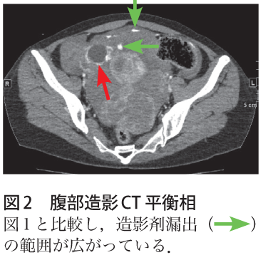 図2　腹部造影CT 平衡相