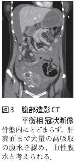 図3　腹部造影CT 平衡相 冠状断像