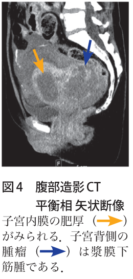 図4　腹部造影CT 平衡相 矢状断像
