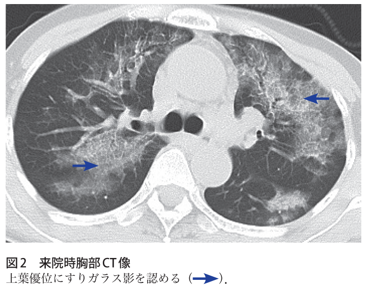 解答 解説 発熱 咳嗽を主訴とした60歳代女性 実践 画像診断q A 羊土社 レジデントノート 羊土社