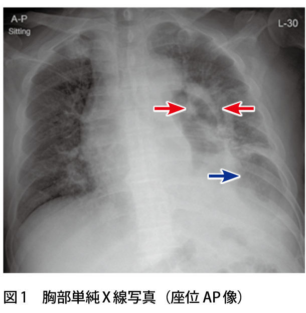 図1　胸部単純X 線写真（座位 AP 像）