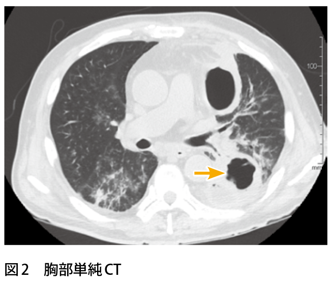 図2　胸部単純CT