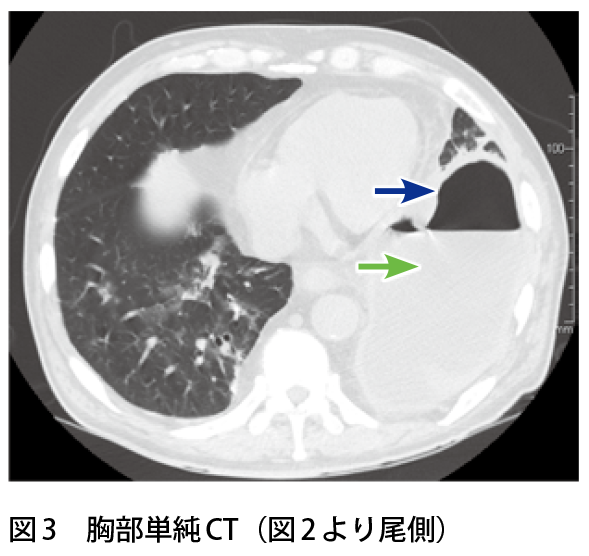 図3　胸部単純CT（図2 より尾側）