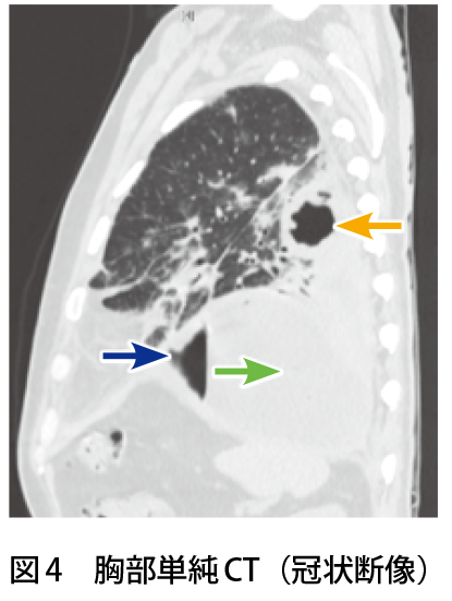 図4　胸部単純CT（冠状断像）