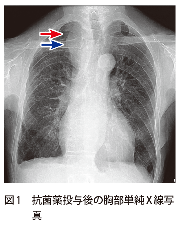 図1　抗菌薬投与後の胸部単純X線写真