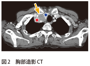 図2　胸部造影CT