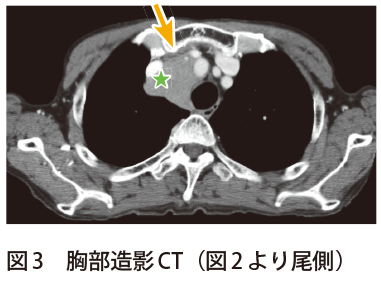 図3　胸部造影CT（図2より尾側）