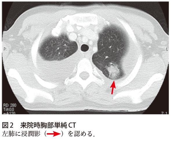 解答 解説 3カ月前から続く咳嗽を主訴に来院した 30歳代女性 実践 画像診断q A 羊土社 レジデントノート 羊土社