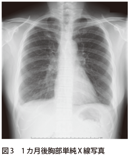 解答 解説 3カ月前から続く咳嗽を主訴に来院した 30歳代女性 実践 画像診断q A 羊土社 レジデントノート 羊土社