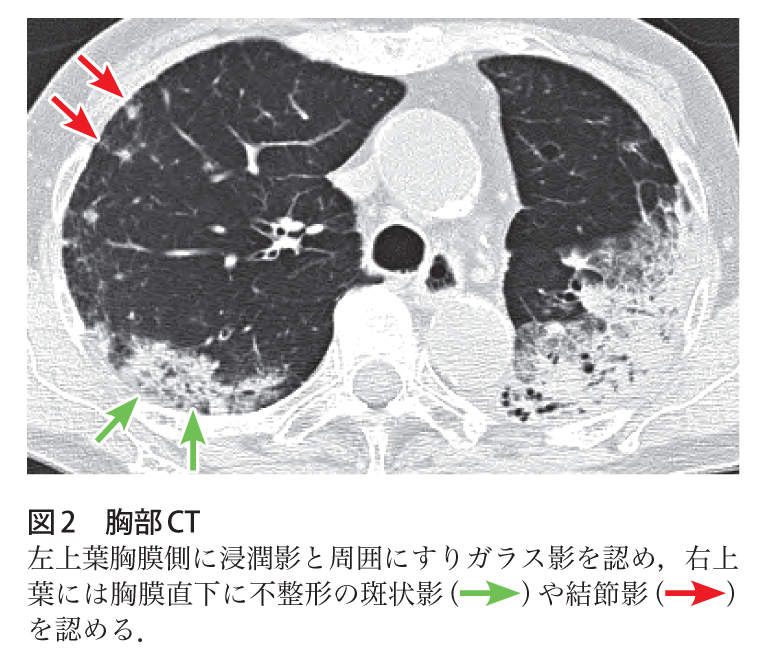解答 解説 咳嗽 喀痰 呼吸困難 食欲不振で受診した70歳代女性 実践 画像診断q A 羊土社 レジデントノート 羊土社