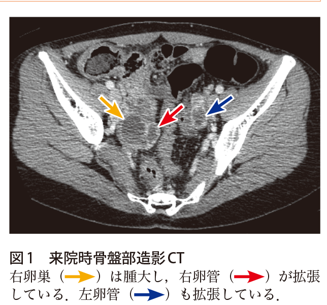 解答 解説 若年女性の下腹部痛 実践 画像診断q A 羊土社 レジデントノート 羊土社