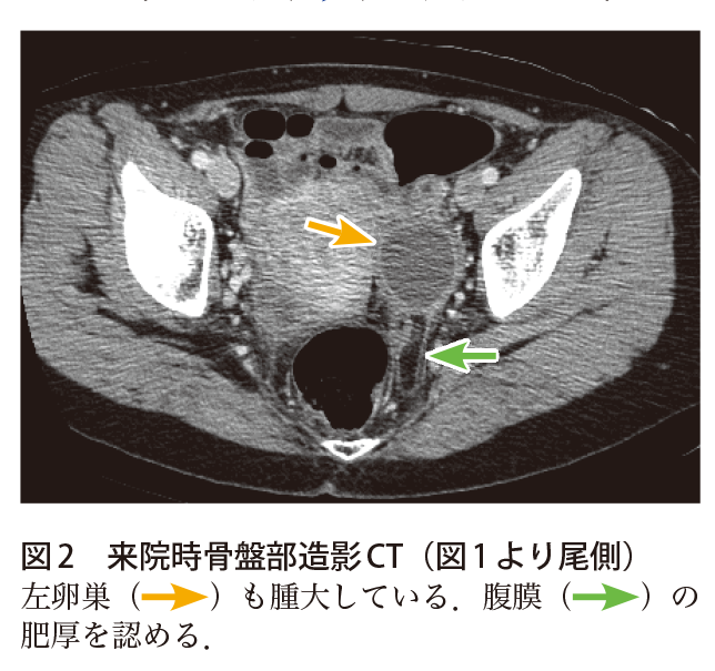 解答 解説 若年女性の下腹部痛 実践 画像診断q A 羊土社 レジデントノート 羊土社