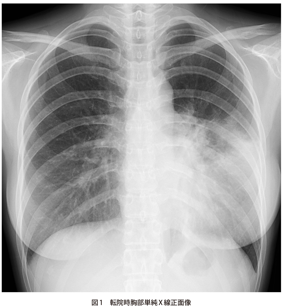 抗菌薬無効の肺炎として紹介された20歳代女性｜実践！画像診断Q&A｜羊土社：レジデントノート 羊土社