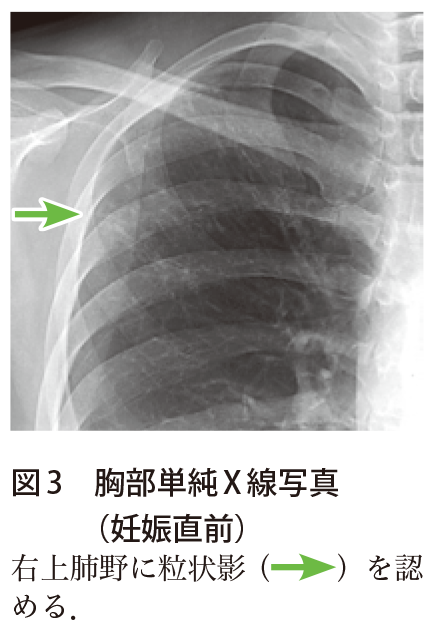 解答 解説 無症状だが 健診で発見された胸部異常陰影で受診した30歳代妊婦 実践 画像診断q A 羊土社 レジデントノート 羊土社
