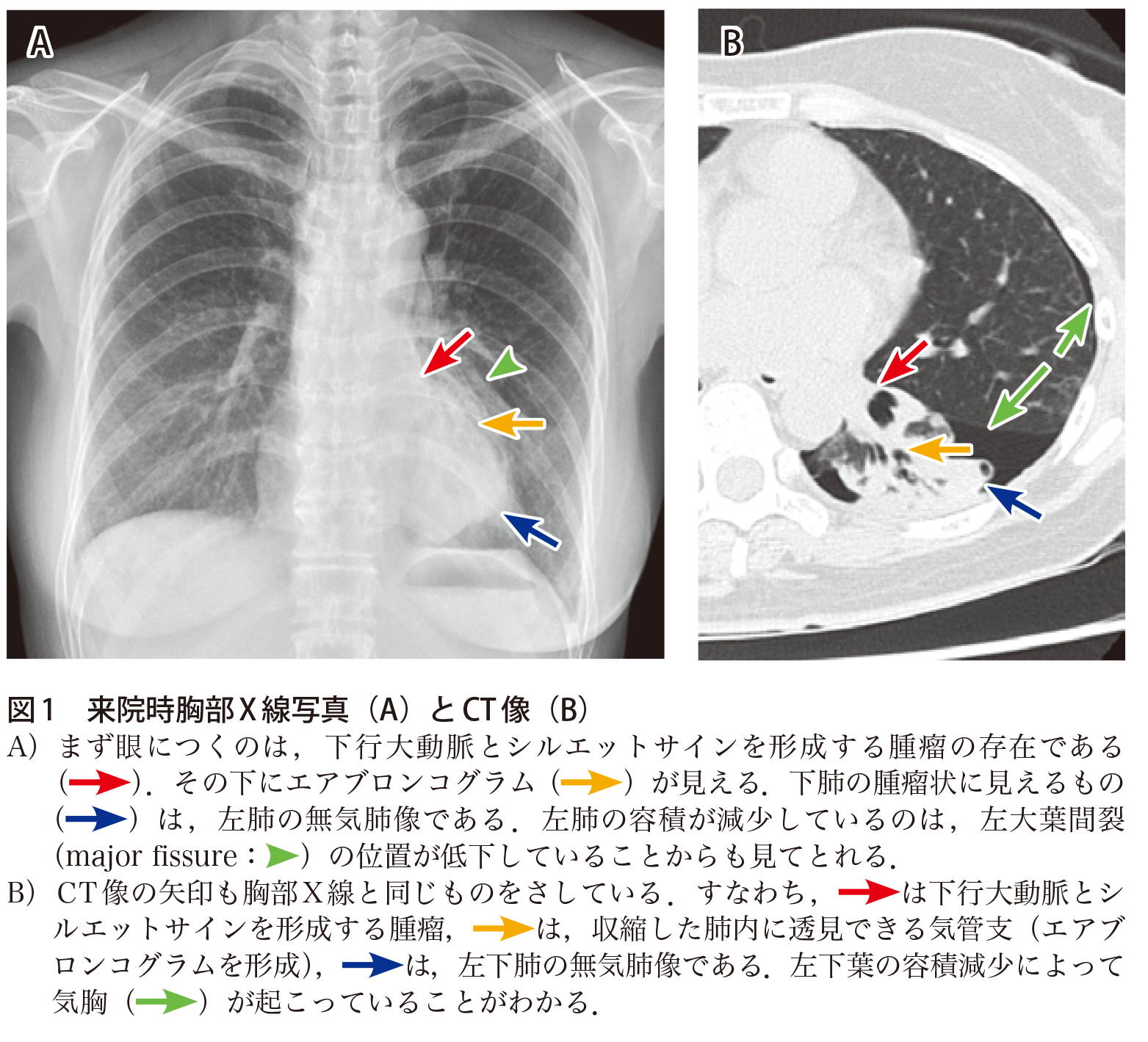 解答 解説 乾性咳嗽を主訴に来院した40歳代女性 実践 画像診断q A 羊土社 レジデントノート 羊土社