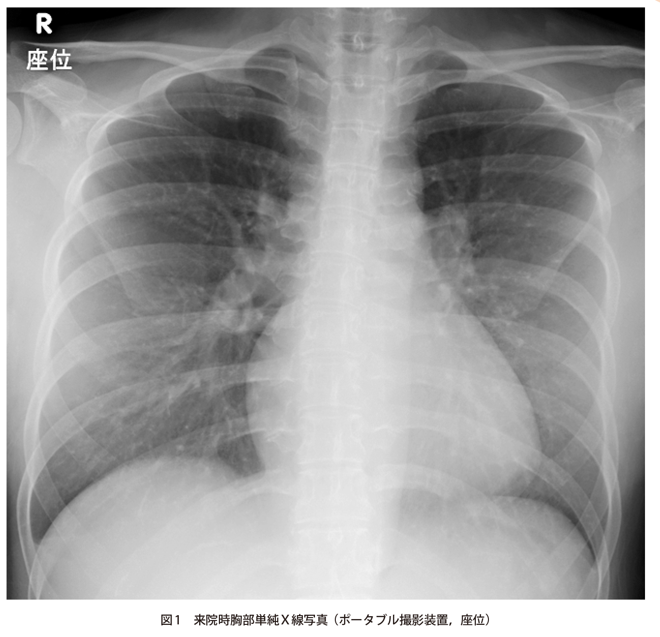突然の呼吸困難で受診した30歳代女性 実践 画像診断q A 羊土社 レジデントノート 羊土社
