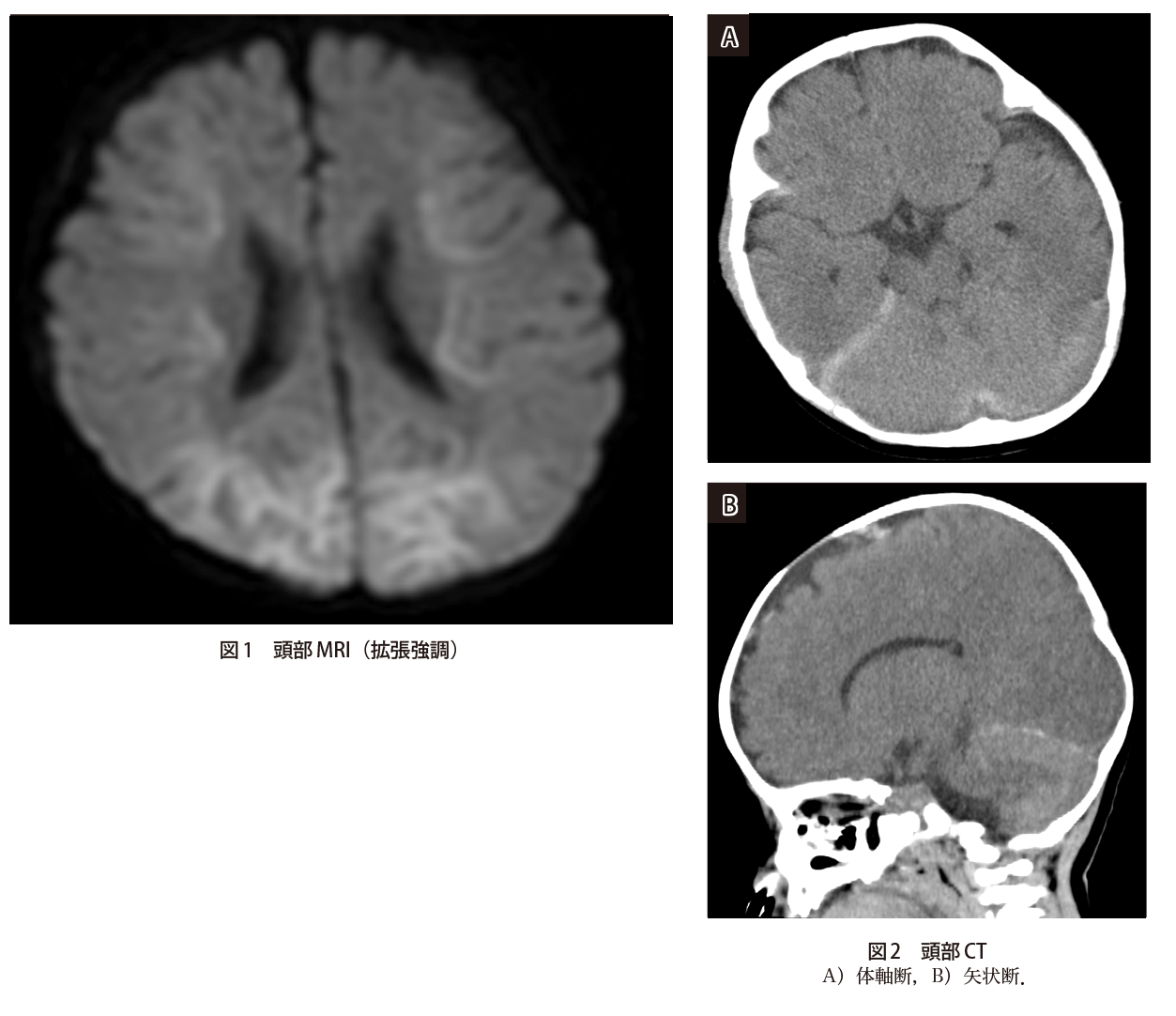 けいれん 意識障害で搬送された5カ月女児 実践 画像診断q A 羊土社 レジデントノート 羊土社