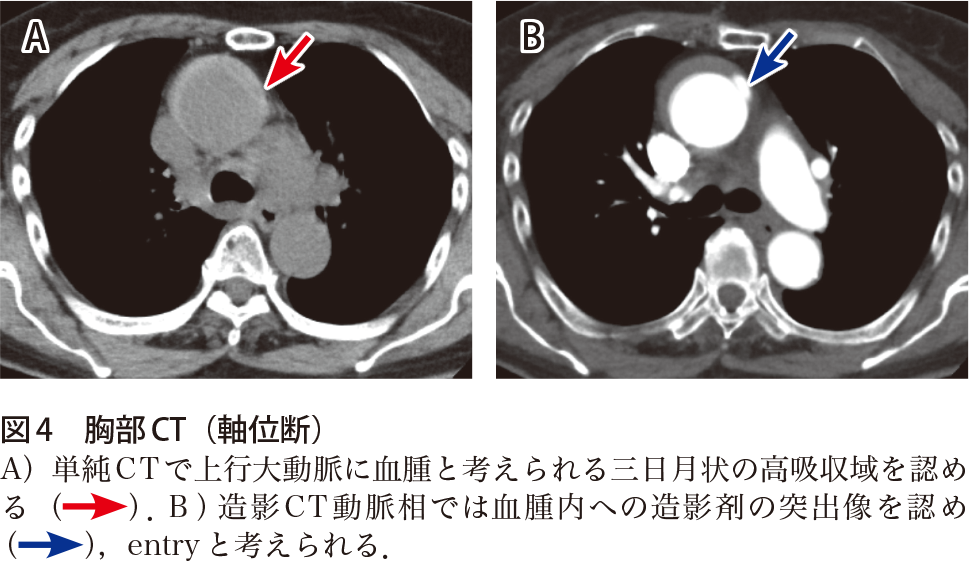 解答 解説 歯痛 両顎部痛 後頸部痛で受診した80歳代女性 実践 画像診断q A 羊土社 レジデントノート 羊土社