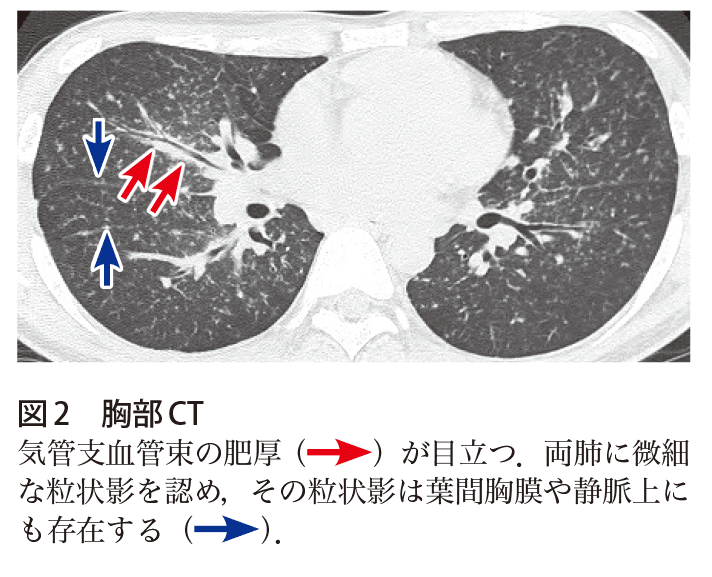 解答 解説 無症状 健診胸部異常影で受診した30歳代男性 実践 画像診断q A 羊土社 レジデントノート 羊土社