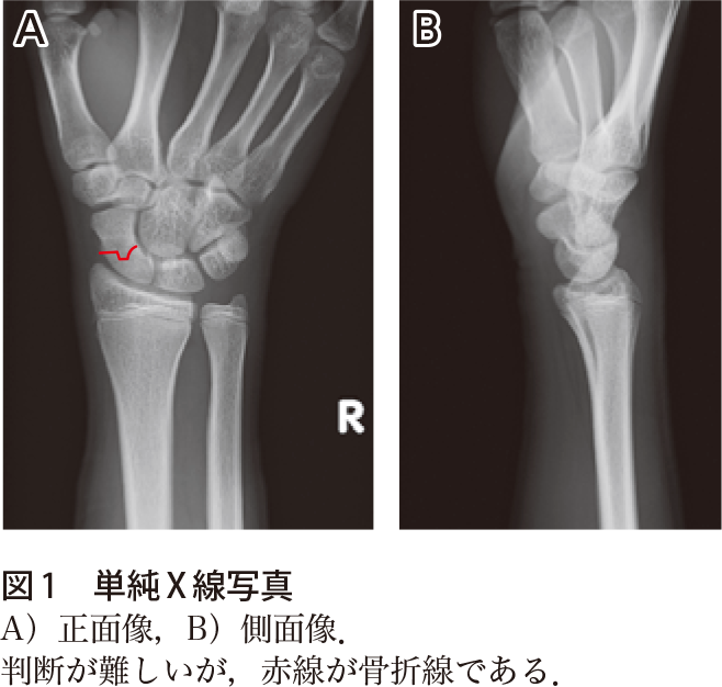 「舟状骨骨折」の画像検索結果