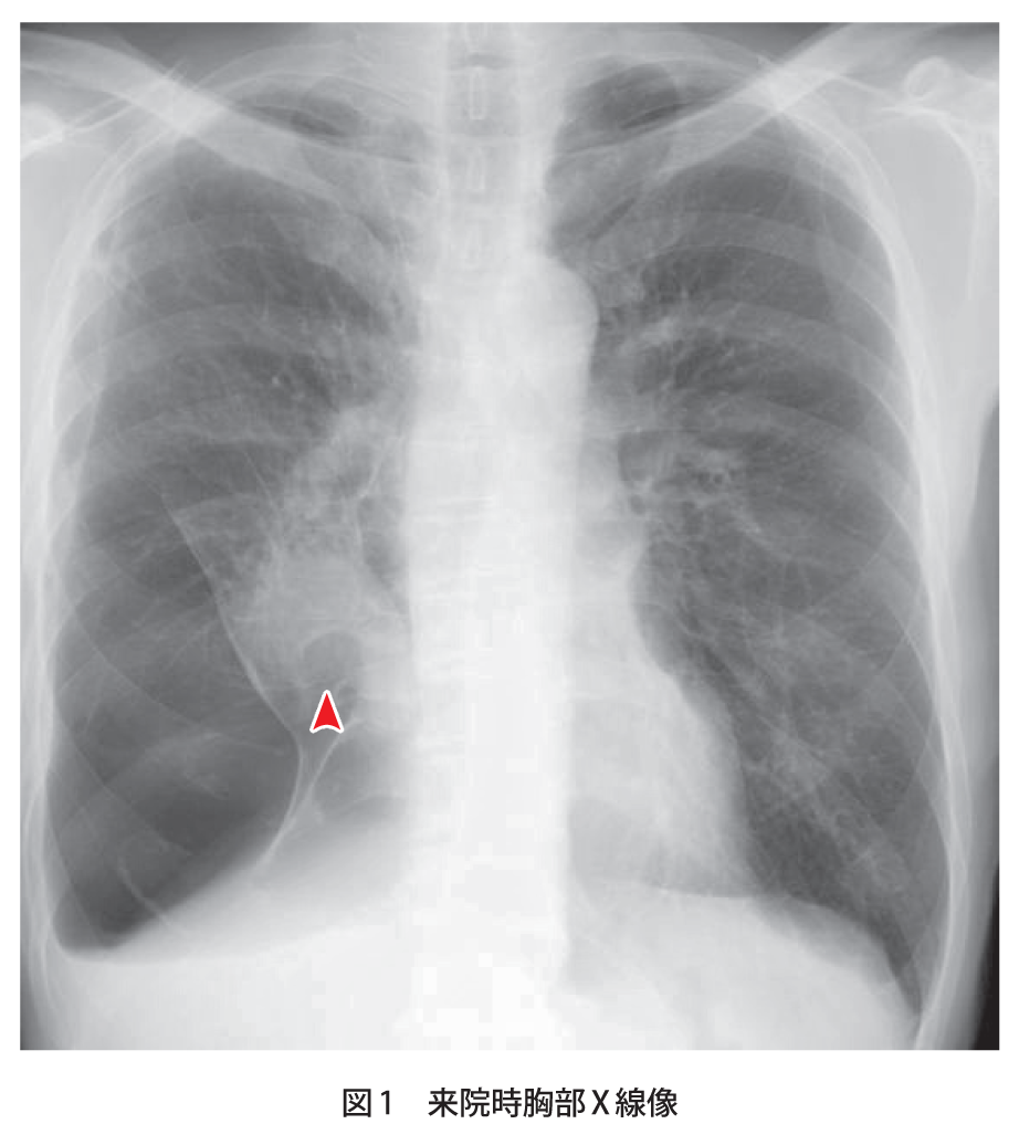 解答 解説 労作時の呼吸困難を主訴とした50歳代男性 実践 画像診断q A 羊土社 レジデントノート 羊土社