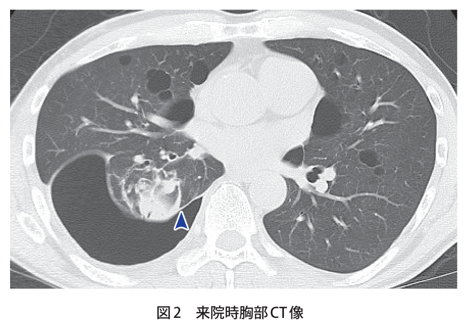 解答 解説 労作時の呼吸困難を主訴とした50歳代男性 実践 画像診断q A 羊土社 レジデントノート 羊土社