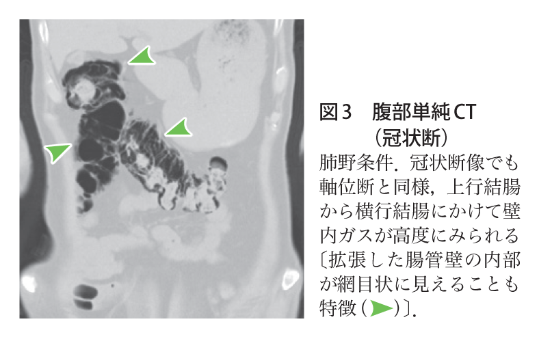 解答・解説】free airを認めるも無症状の70歳代男性|実践!画像診断