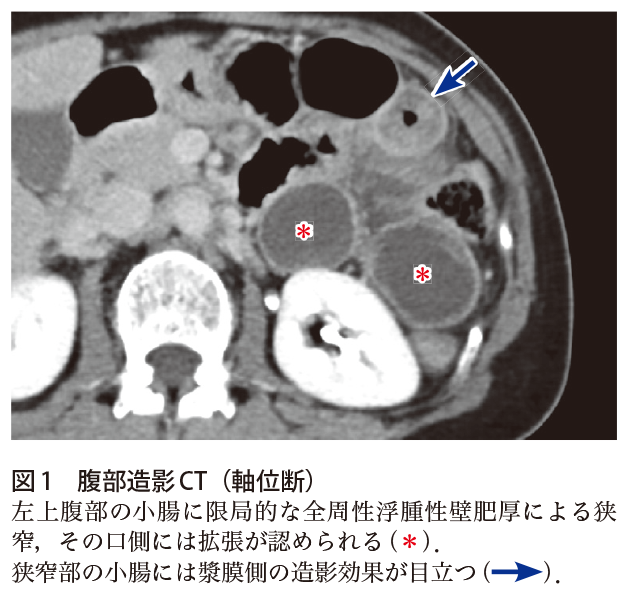 解答 解説 腹痛と嘔吐で受診した40歳代女性 実践 画像診断q A 羊土社 レジデントノート 羊土社