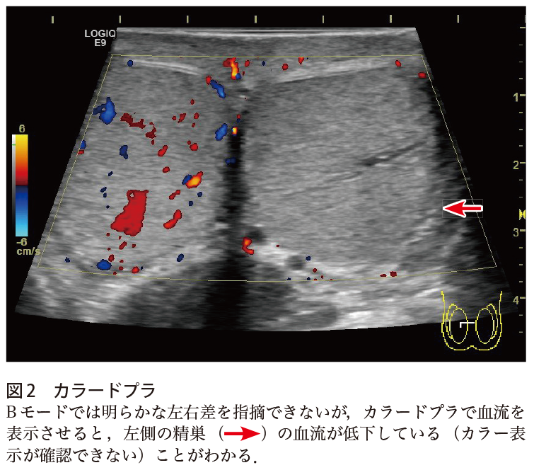 解答 解説 急性の陰嚢痛で受診した10歳代後半男性 実践 画像診断q A 羊土社 レジデントノート 羊土社