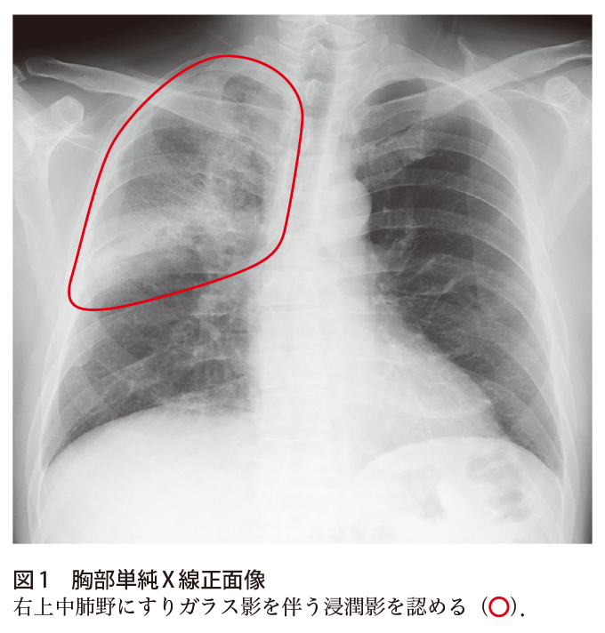 解答 解説 発熱と呼吸困難を主訴とした50歳代男性 実践 画像診断q A 羊土社 レジデントノート 羊土社